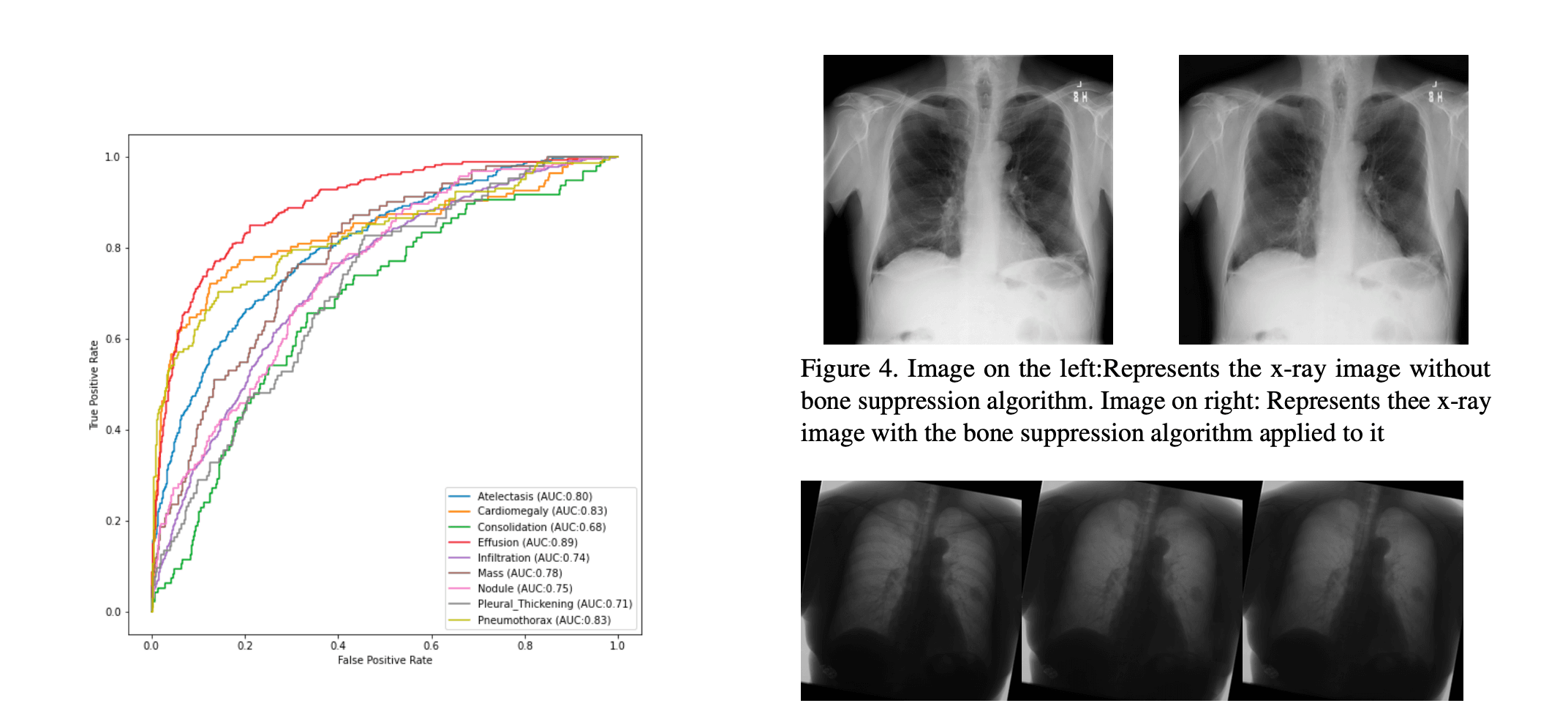 Effect of Bone Suppression on X-Ray Classification project preview